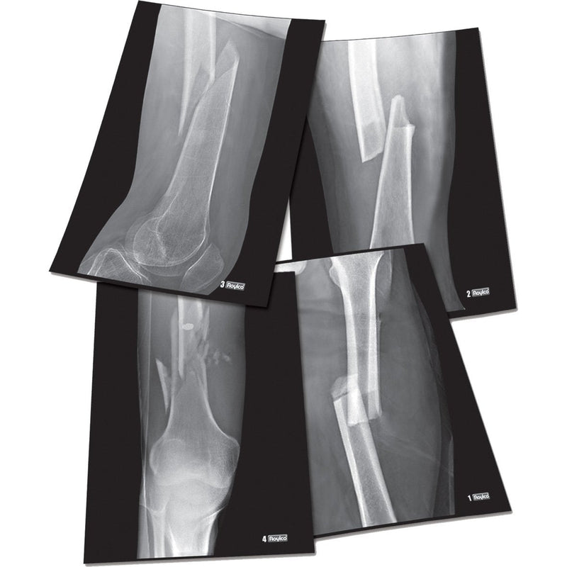 Fracture X-Rays pk 4